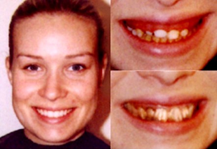Dental Appliance Dental Appliance